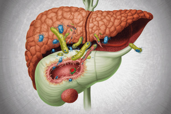 Acute and Chronic Cholangitis Applications